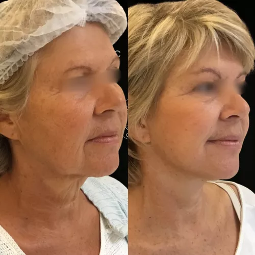 Lifting total du visage et du cou -1