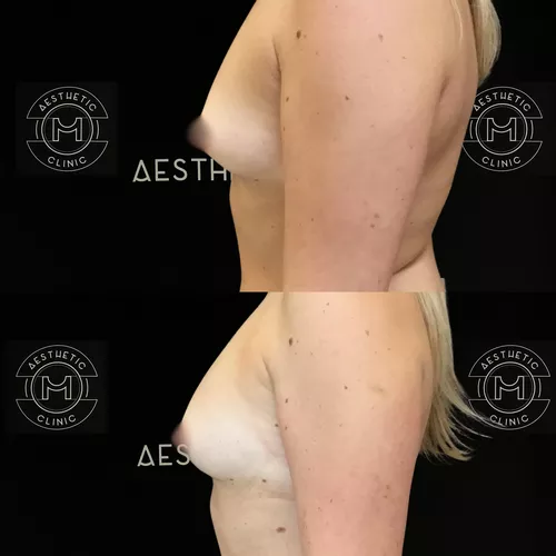 augmentation-mammaire-par-graisse-1-avant-apres