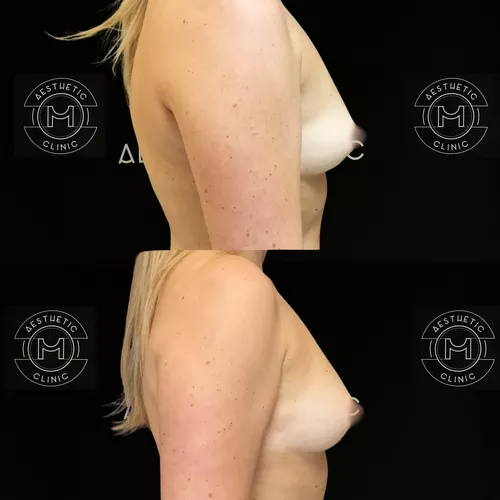 augmentation-mammaire-par-graisse-2-avant-apres