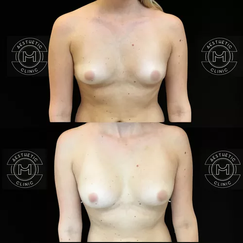 vaugmentation-mammaire-par-graisse-3-avant-apres