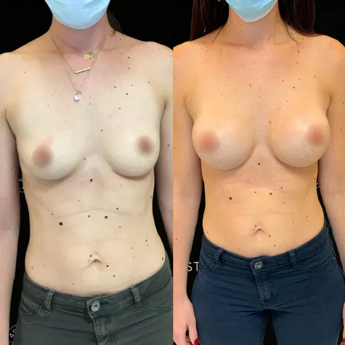 augmentation-mammaire-par-prothèses-2