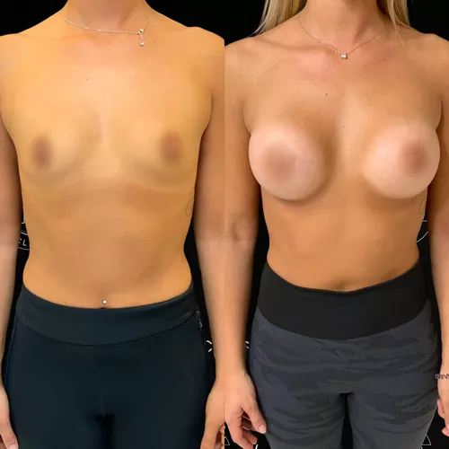 augmentation-mammaire-par-prothèses-3