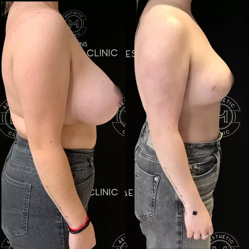 4-a-ii-5-reduction-mammaire-avant-apres-1