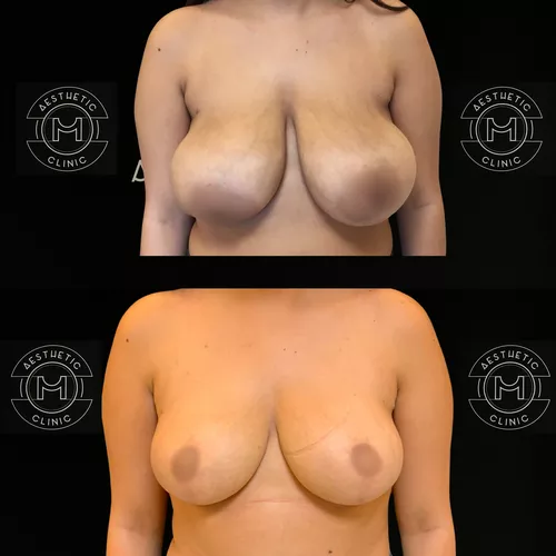 4-a-ii-5-reduction-mammaire-avant-apres-2