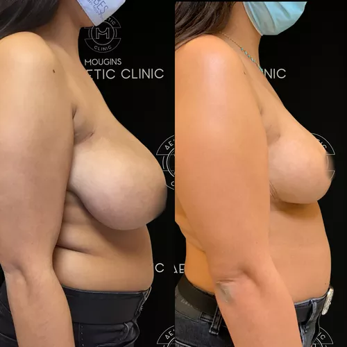 4-a-ii-5-reduction-mammaire-avant-apres-3