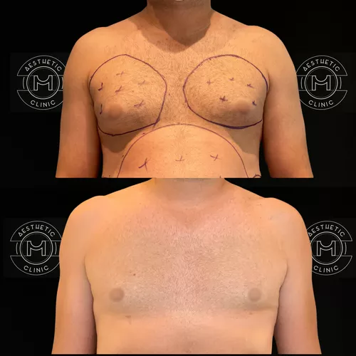 4-a-ii-6-gynecomastie-avant-apres-1