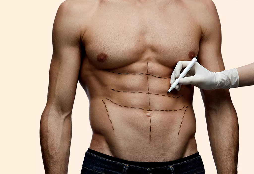 Abdominal etching