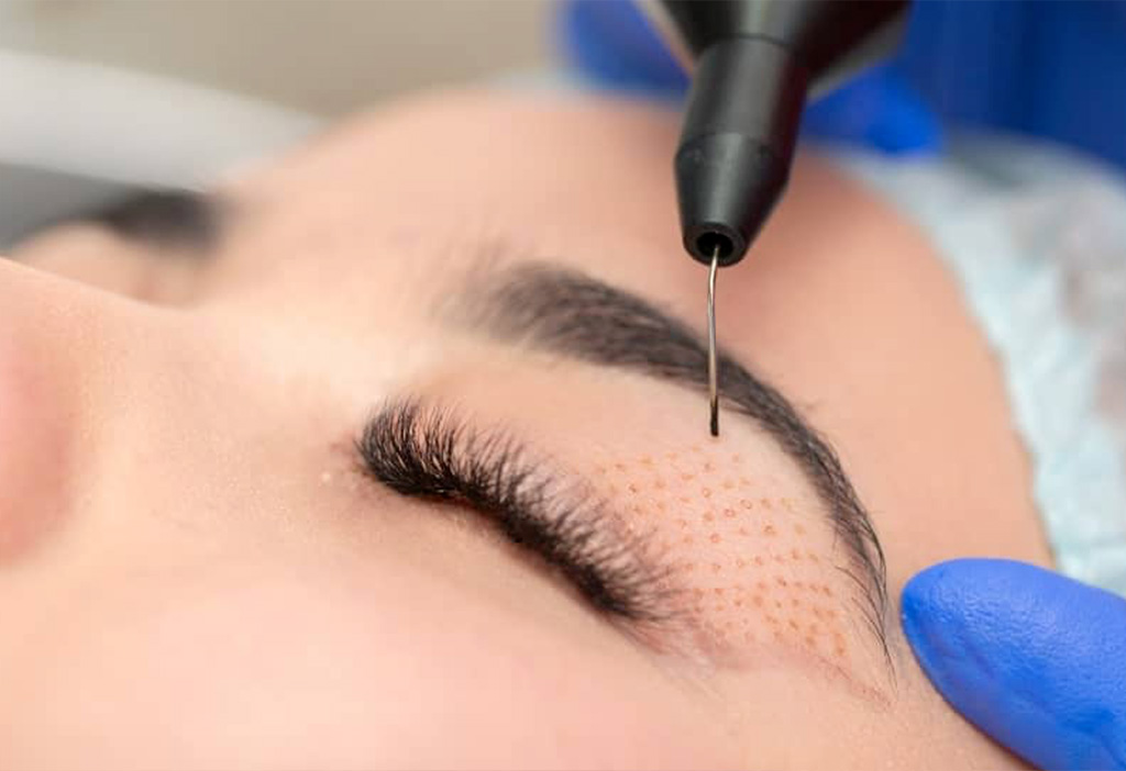 PlexR des paupières inférieures