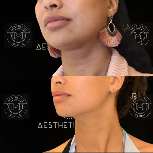 Liposuccion du cou-1-avant-apres