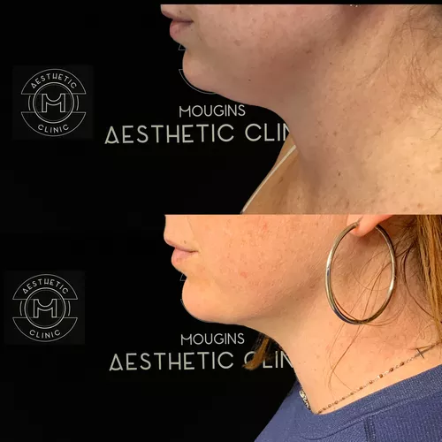 Liposuccion du cou-2-avant-apres