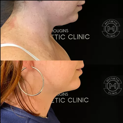 Liposuccion du cou-3-avant-apres