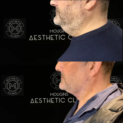 Renuvion du cou-2-avant-apres