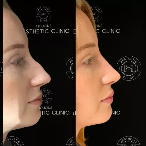 Rhinoplastie-1