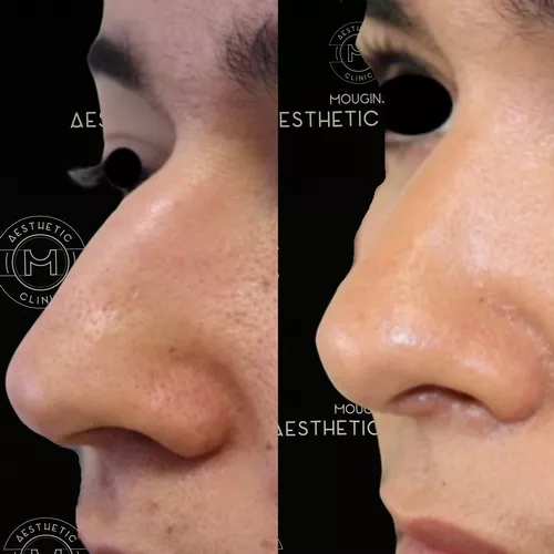 Rhinoplastie-2
