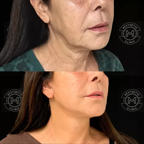 Semi Lifting du visage et du cou-1