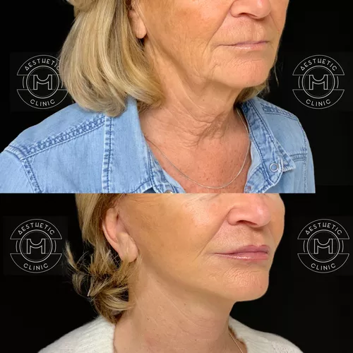 Semi Lifting du visage et du cou-2