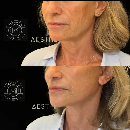 Semi Lifting du visage et du cou-4