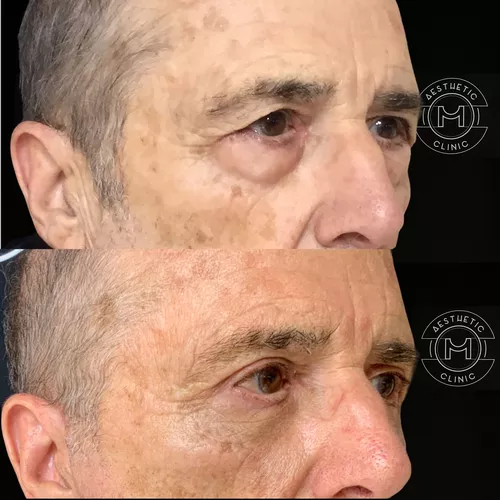 blepharoplastie-1