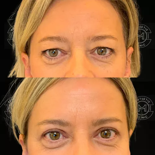 blepharoplastie-3