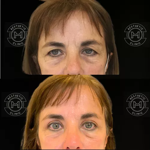 blepharoplastie-5