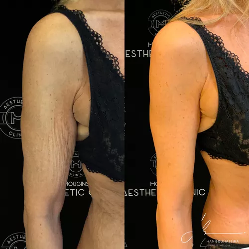 lifting-des-bras-2-avant-apres