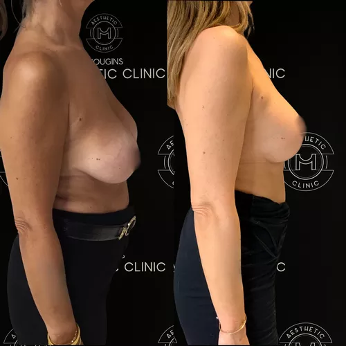 lifting-des-seins-1-avant-apres