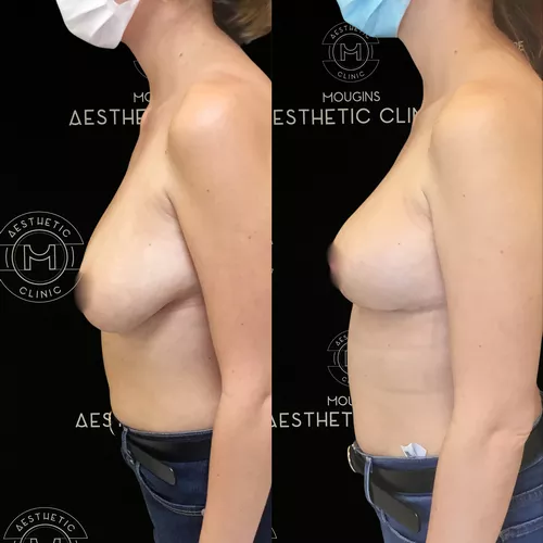 lifting-des-seins-2-avant-apres