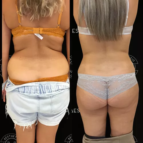 liposuccion-du-ventre-2-avant-apres