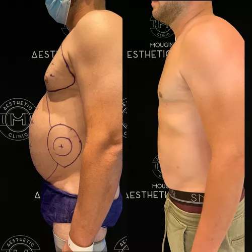 liposuccion-du-ventre-3-avant-apres