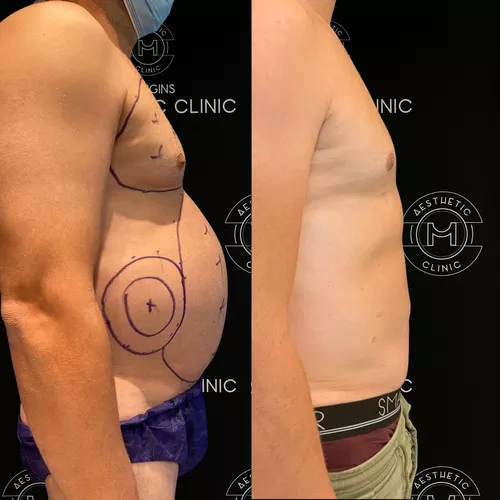 liposuccion-du-ventre-4-avant-apres