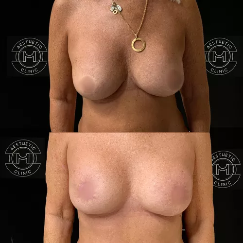 plastie-prothese-1-avant-apres