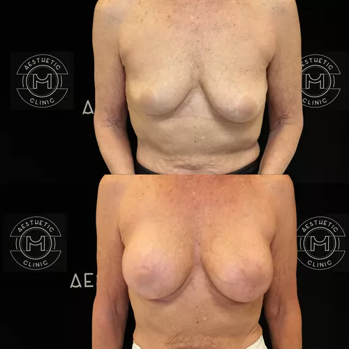 plastie-prothese-3-avant-apres