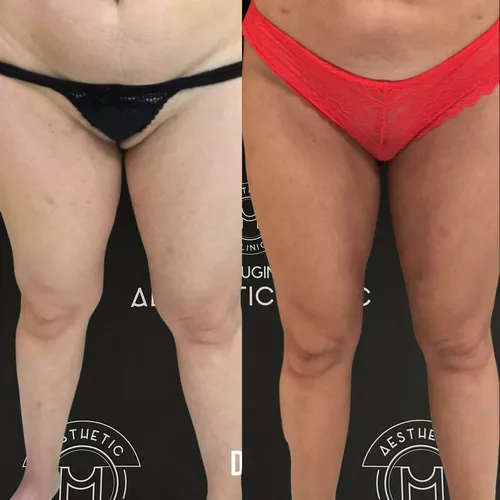 traitement-du-lipoedeme-2-avant-apres