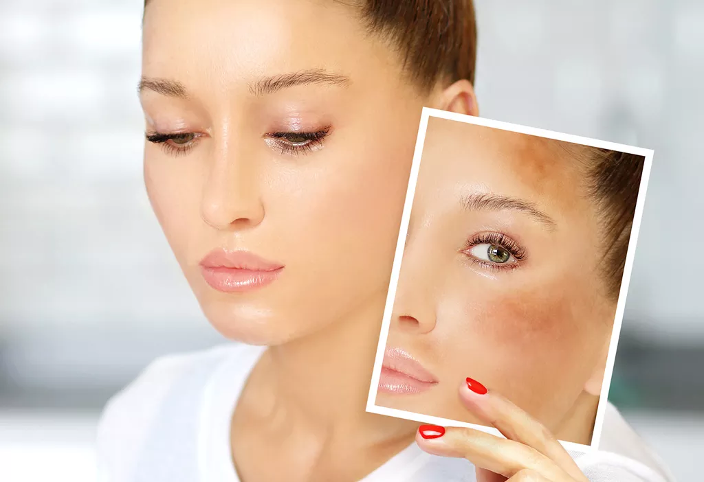 Soigner les taches sur la peau