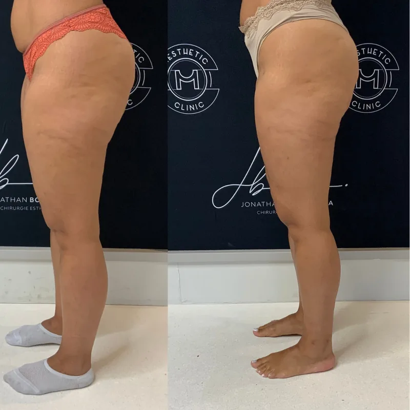 Traitement du lipœdème, cas 1 : jambes de profil, avant / après