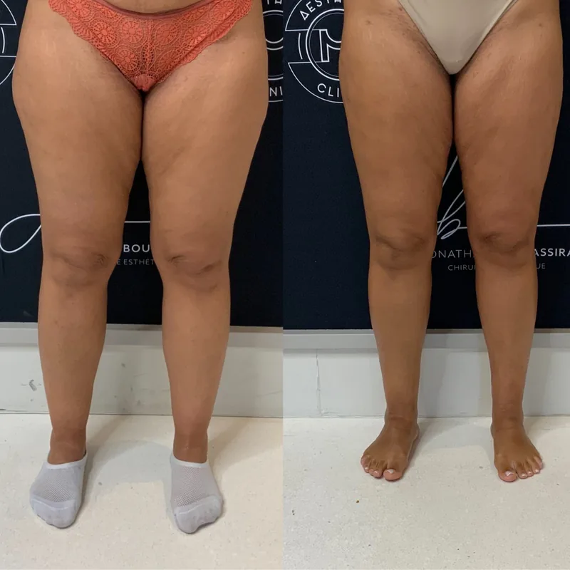 Traitement du lipœdème, cas 1 : jambes de face, avant / après