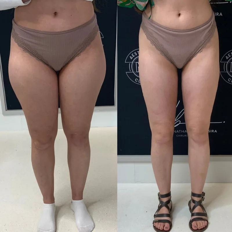 Traitement du lipœdème, cas 2 : jambes de face, avant / après