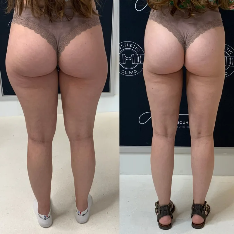 Traitement du lipœdème, cas 2 : jambes de dos, avant / après