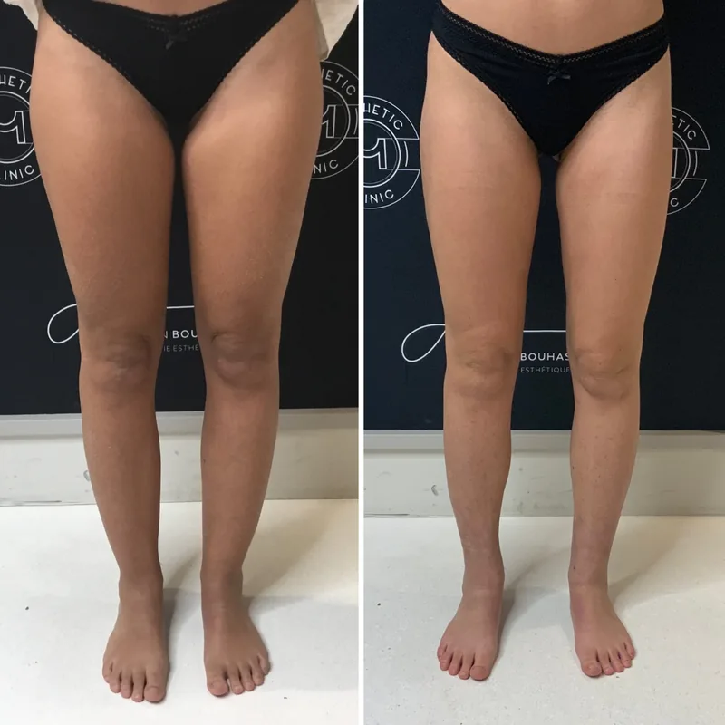 Traitement du lipœdème, cas 3 : jambes de face, avant / après