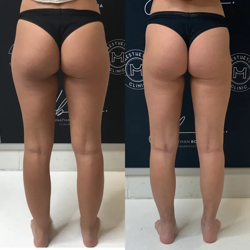 Traitement du lipœdème, cas 3 : jambes de dos, avant / après