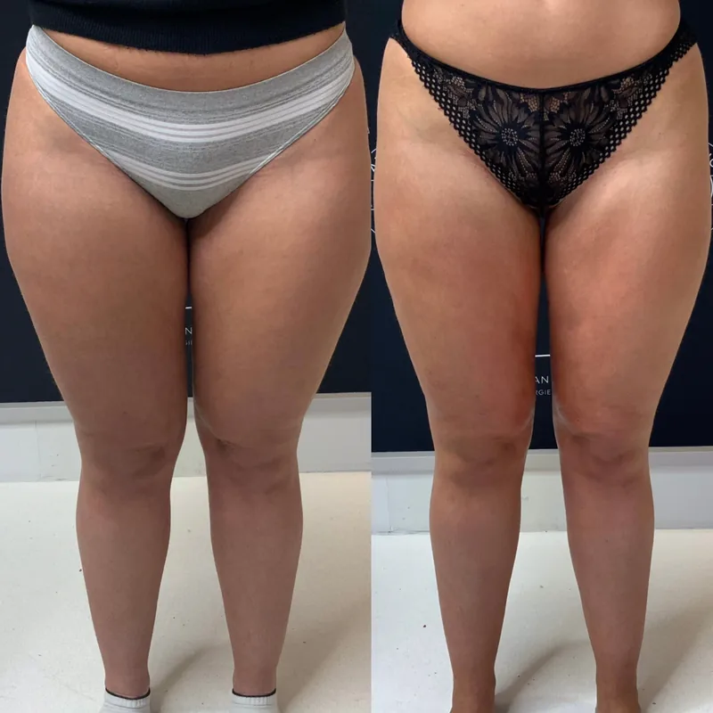 Traitement du lipœdème, cas 4 : jambes de face, avant / après
