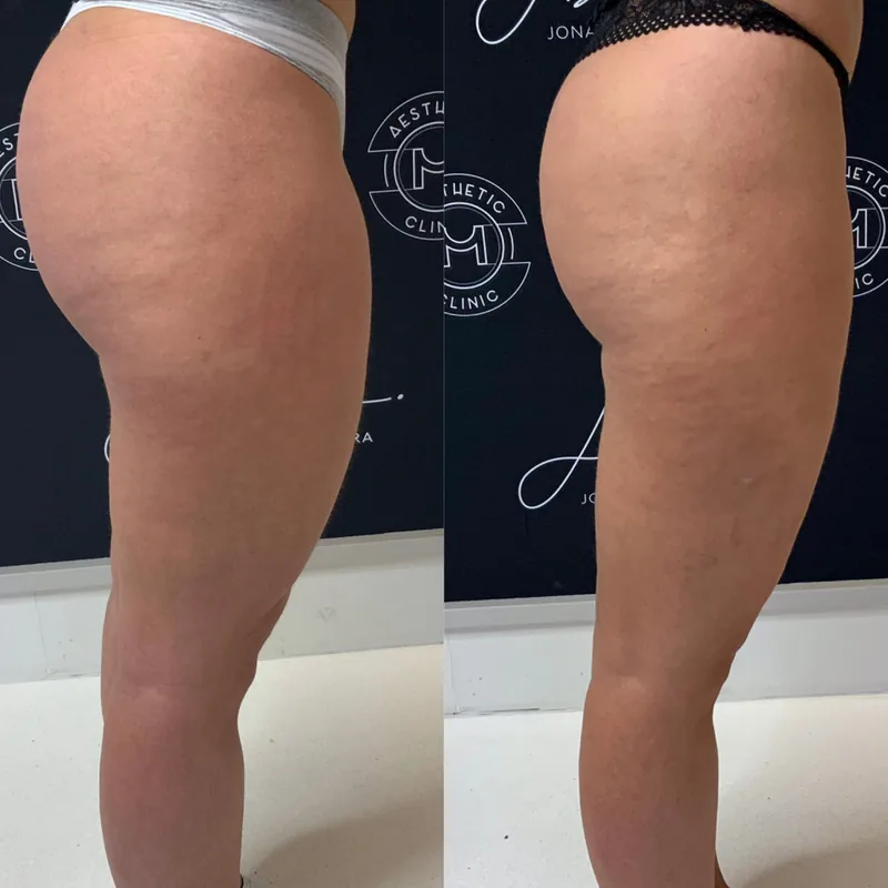 Traitement du lipœdème, cas 4 : cuisse de profil, avant / après