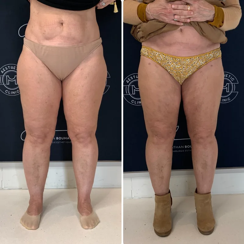 Traitement du lipœdème, cas 6 : jambes de face, avant / après