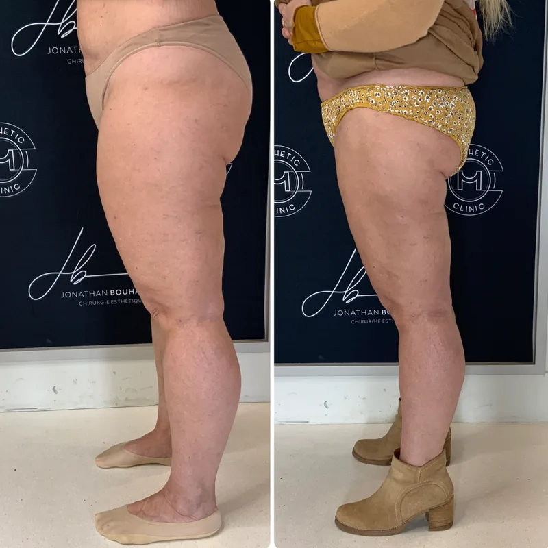 Traitement du lipœdème, cas 6 : jambes de profil, avant / après