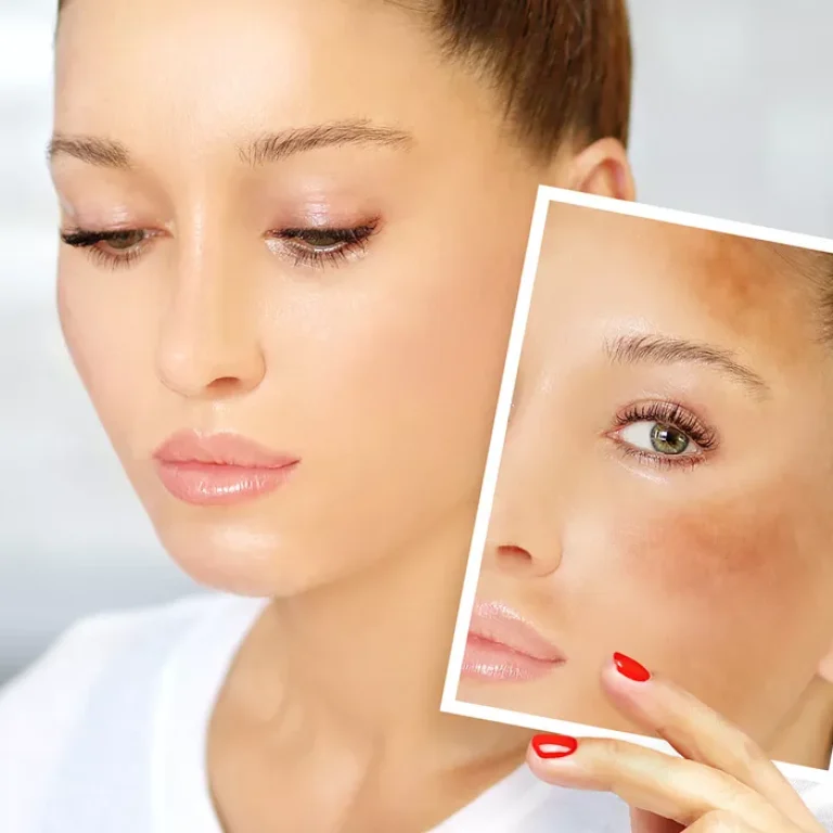 Soigner les taches sur la peau