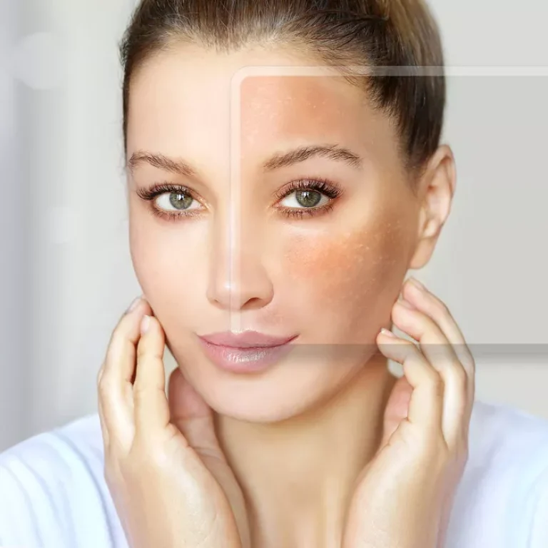 Soigner les rougeurs