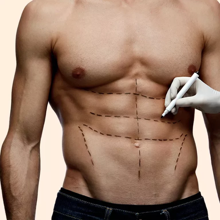 Abdominal etching