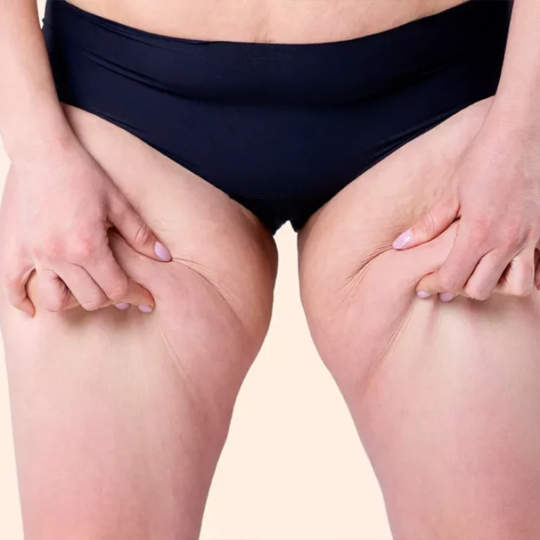 Le traitement du Lipoedème