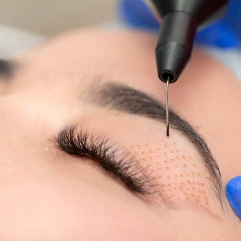 PlexR des paupières inférieures