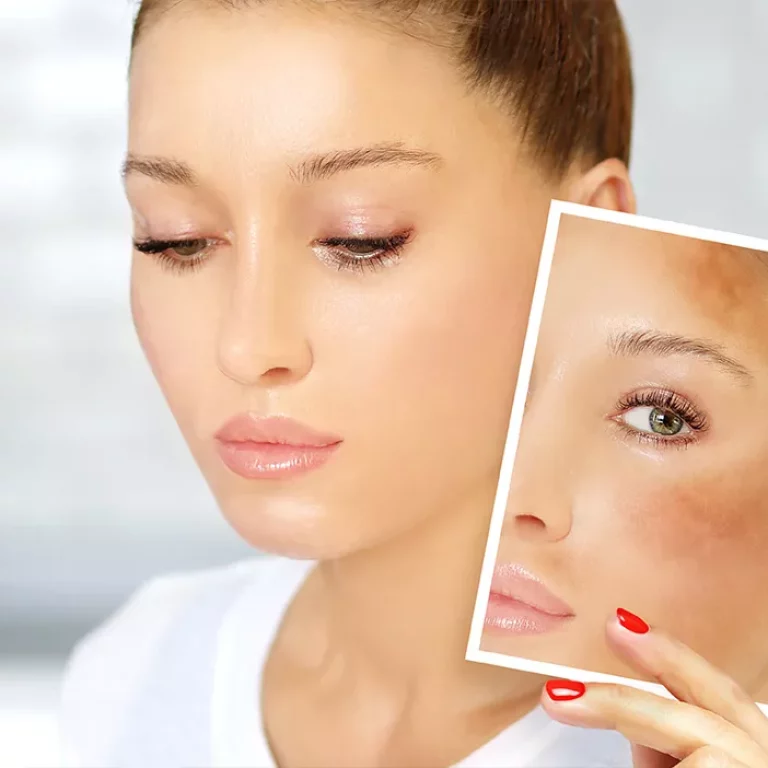 Lumière intense pulsée Lutronic